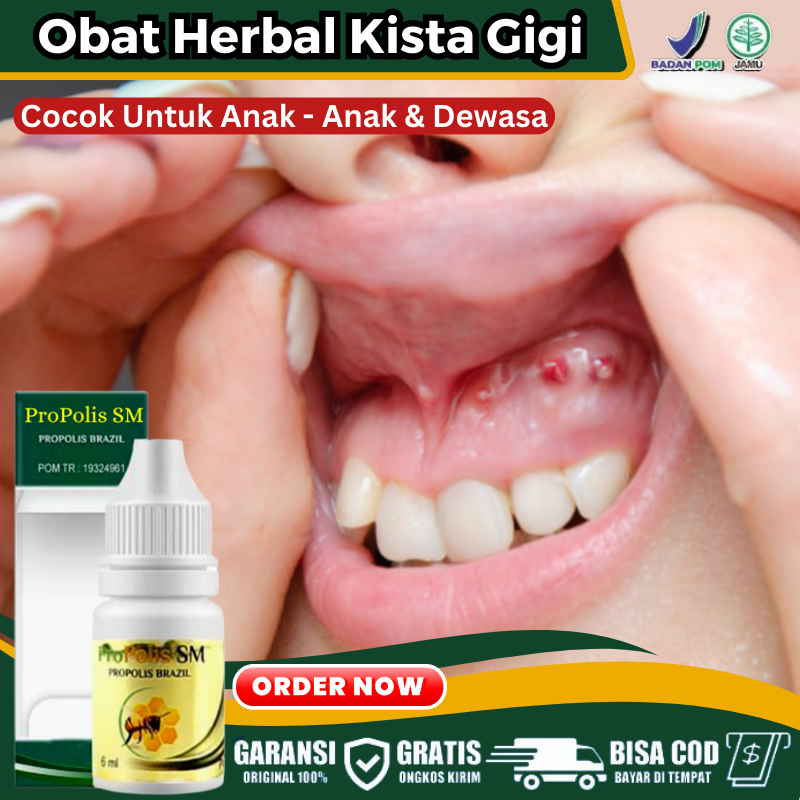 Obat Herbal Kista Gigi Pada Anak & Dewasa, Obat Benjolan Berisi Cairan di Sekitar Gigi & Gusi, Obat 