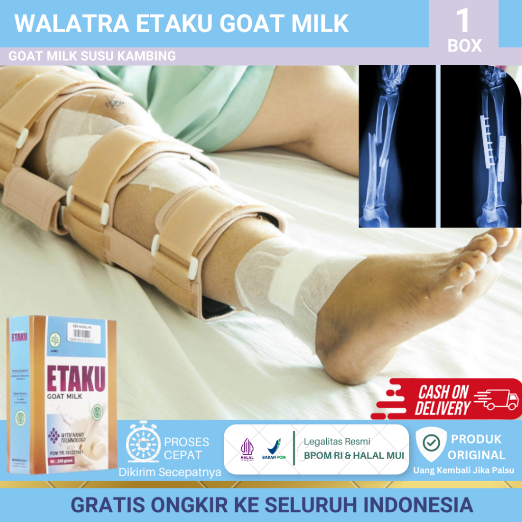 Susu Kalsium Patah Tulang, Penyembuh Patah Tulang, Tulang Retak, Tulang Remuk, Patah Tulang Kaki Dan