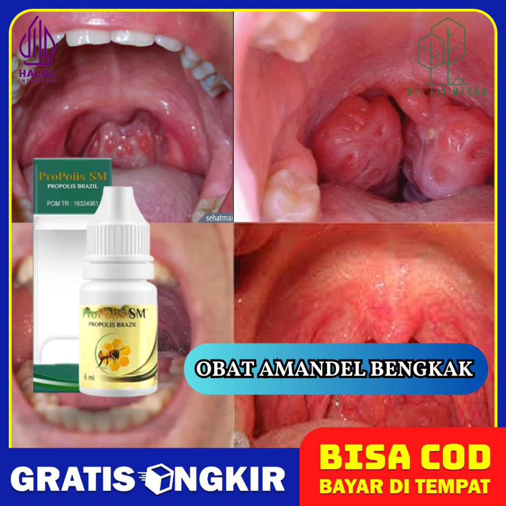 Propolis SM - Obat Amandel Bengkak, Amandel Anak Bengkak Sebelah, Bercak Putih di Amandel Cepat Kemp