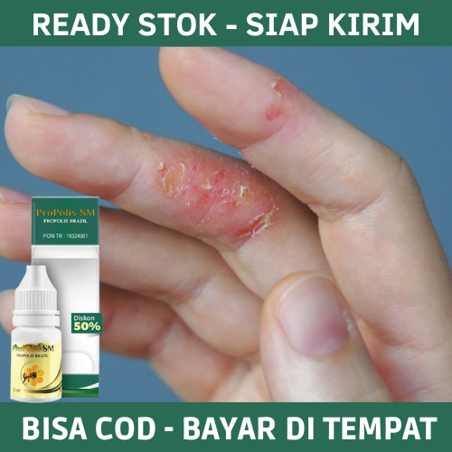 Obat Gatal Berair di Jari Tangan Dan Kaki, Obat Gatal Berair di Jari Tangan, Obat Gatal Berair, Obat