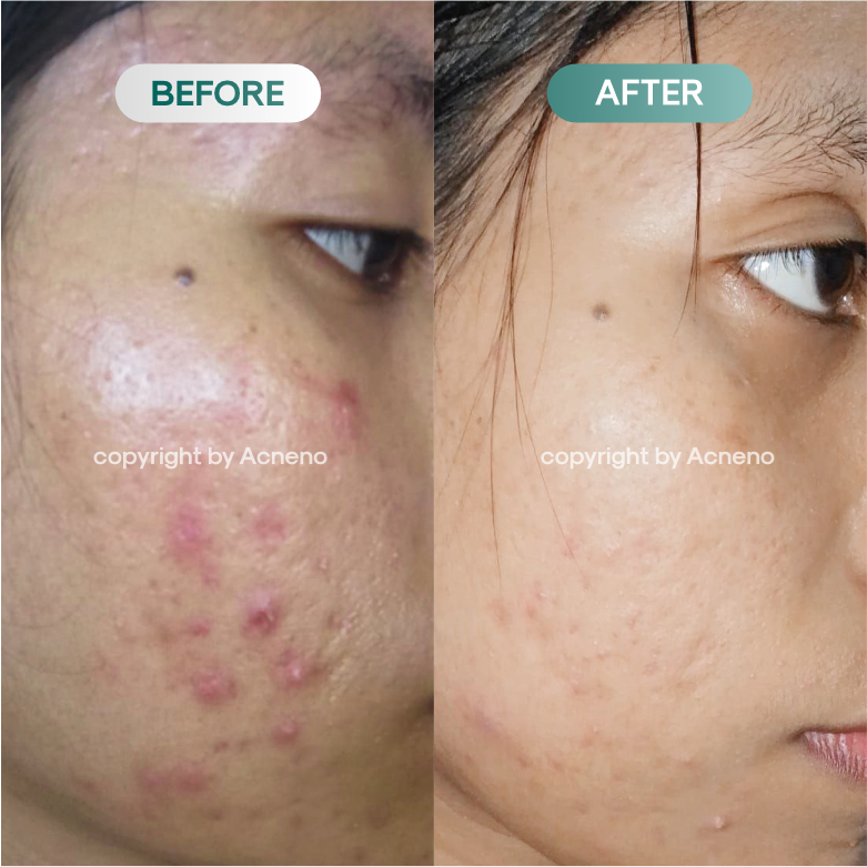 (LIVE) Paket Perawatan Jerawat Bruntusan Bebas Komedo - ACNENO | Rangkaian Basic Skincare Merawat Wajah Berjerawat dan Melembabkan Wajah