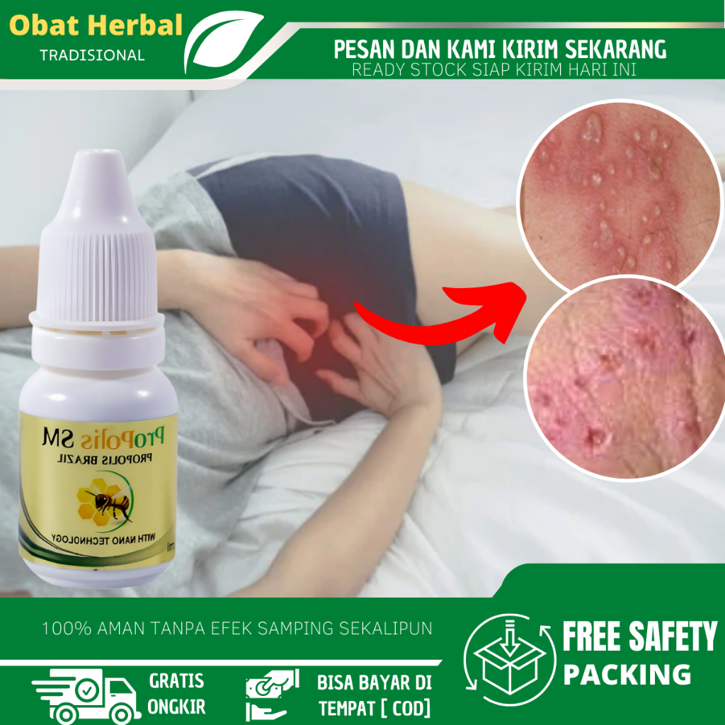 Obat Vagina Lecet, Obat Luka Di Vagina, Obat Vagina Gatal,  Obat Gatal Miss V, Obat Gatal Jamur Vagi