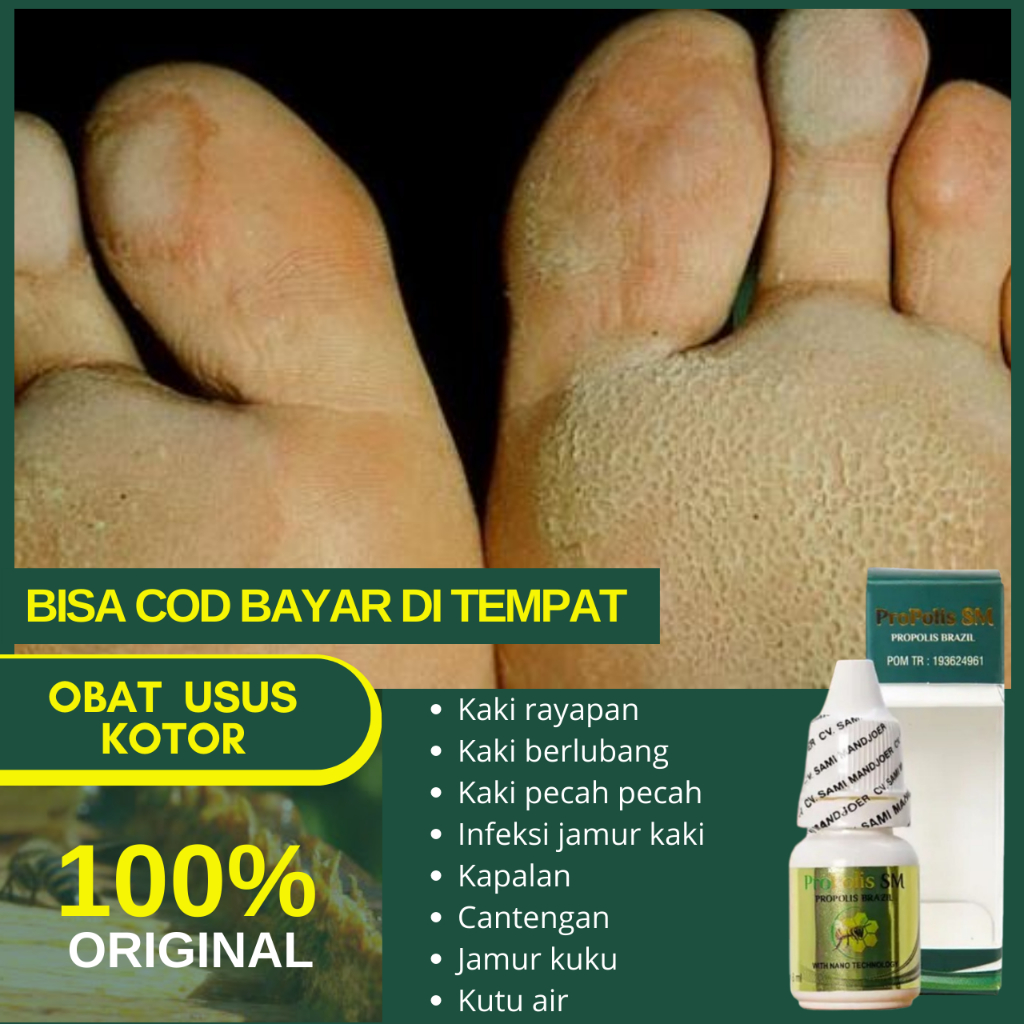 Obat Kaki Rayapan - Telapak Kaki Bolong Bolong - Kaki Berlubang - Kapalan - Rorombeheun Propolis SM