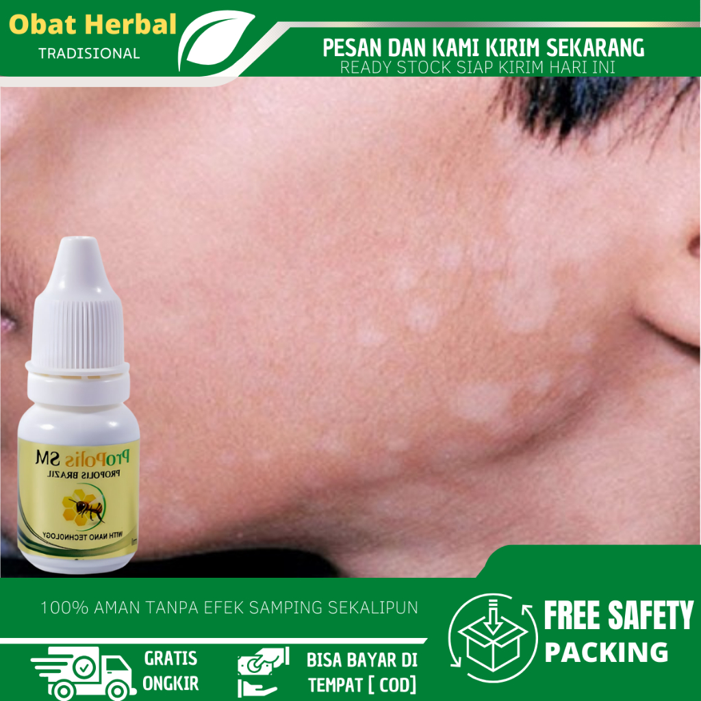 Obat Oles Penghilang Panu Di Wajah, Obat Penghilang Panu Anak dan Dewasa, Obat Hapuran, Balas Bogo, 