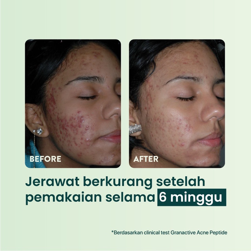 NPURE Spot Treatment acne spot dark spot N’pure npure n pure