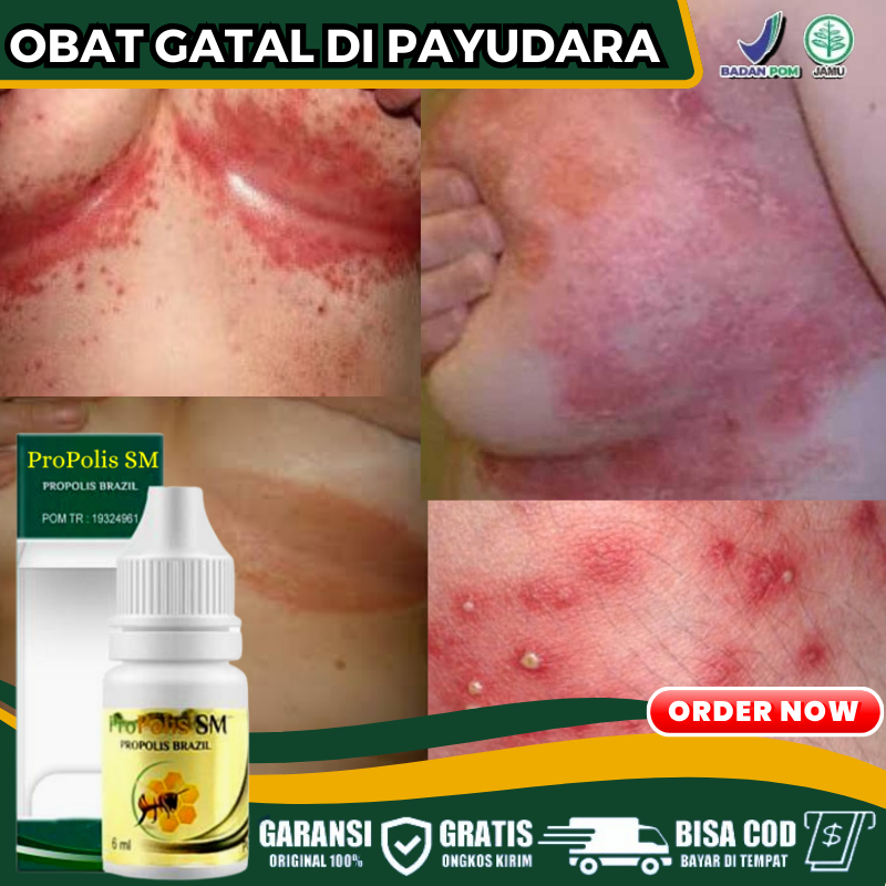 Obat Oles Pengering Lipatan Payudara Lecet, Obat Penghilang Gatal di Lipatan Payudara, Atasi Ruam Me