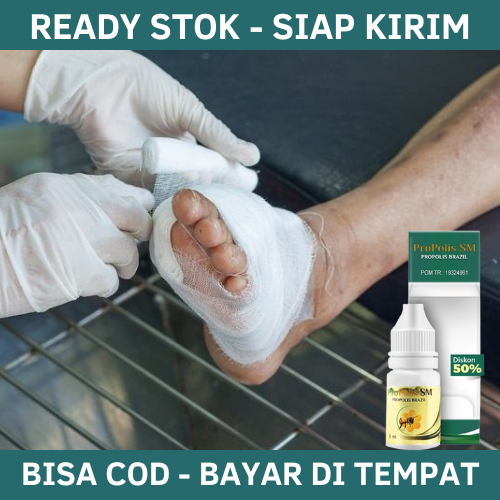 Obat Luka Diabetes, Obat Pengering Luka Gangren Diabetes Melitus, Obat Luka Diabetes Agar Cepat Keri