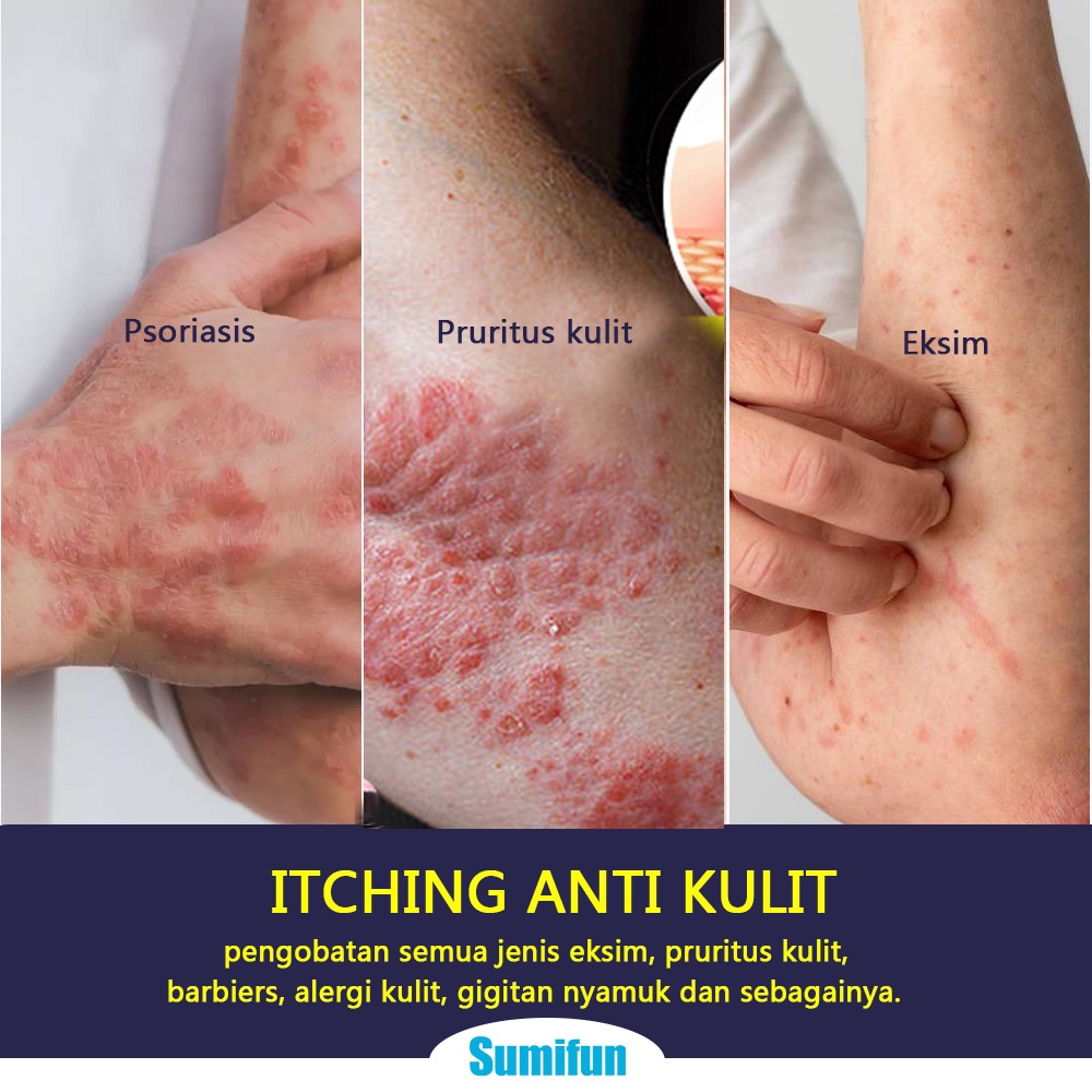 Salep jamur kulit salep eksim salep gatal paling ampuh salep gatal 30g Kulit Kepala Psoriasis Tangan Tinea Kaki Bau Versicolor Menghambat Dermatitis Jamur Anti Gatal Cream Menghambat Dermatitis Jamur Anti Gatal Cream