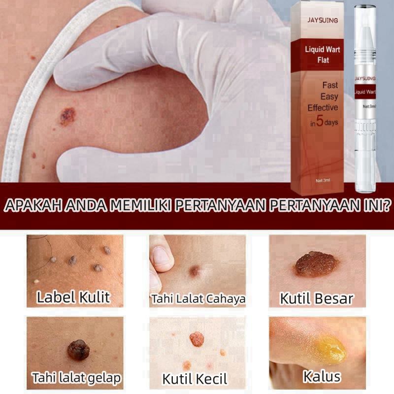 Penghilang kutil wart remover pen Penghilang Tahi Lalat Penghilang Kutil Skin Tag Remover Menghilangkan Tahi Lalat