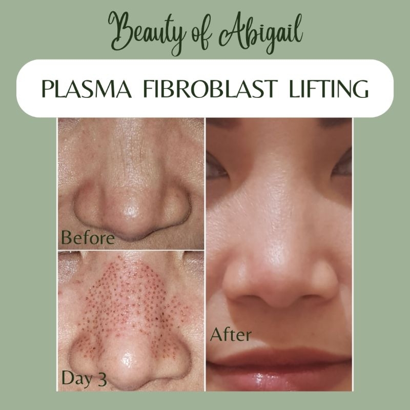 Plasma Fibroblast Lifting / Plasma Lifting Treatment