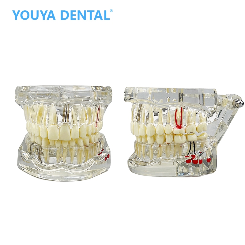 youya Model study gigi edukasi transparan studi implant phantom crown karies bridge bening impaksi m