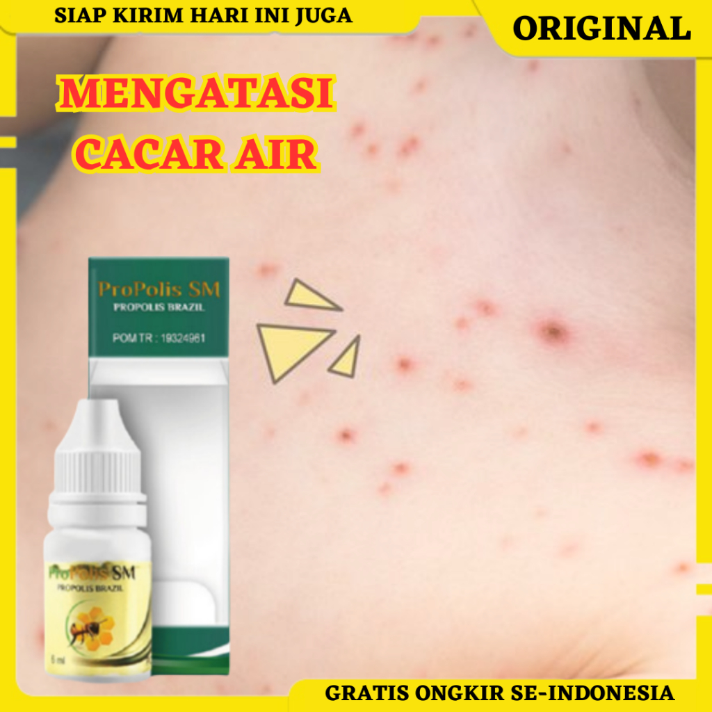 Propolis SM, Obat Cacar Air, Obat Cacar Gatal, Obat Cacar Bintik Berair, Obat Cacar Bernanah, Obat C