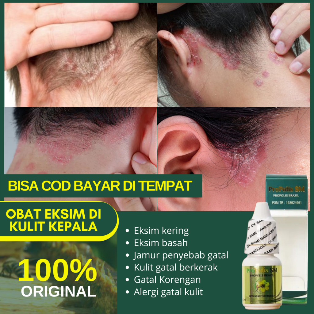 Obat Eksim Di Kulit Kepala, Dermatitis Seboroik Kepala, Kulit Kepala Berjamur Gatal Korengan Berkera