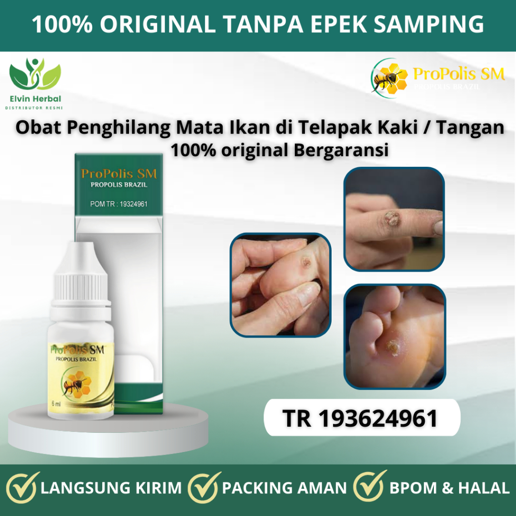 Obat Mata Ikan Pada Telapak Kaki, Obat Penghilang Mata Ikan di Telapak Kaki / Tangan, Obat Mata Ikan