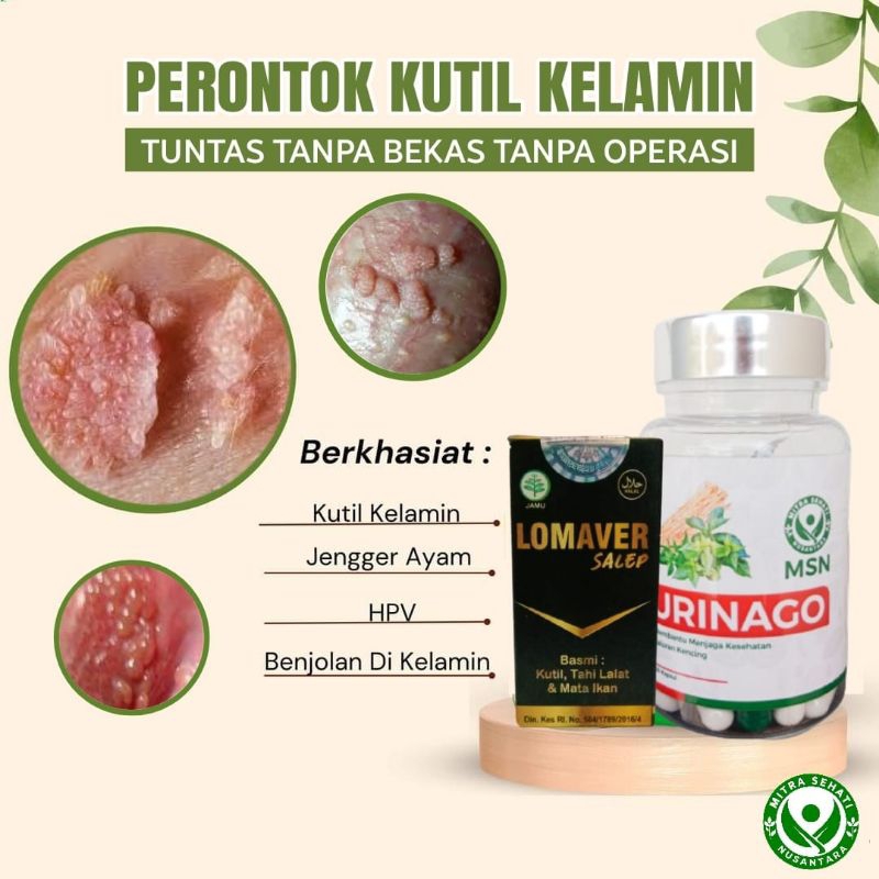 OBAT HERBAL KUTIL KELAMIN HPV HIV AMPUH