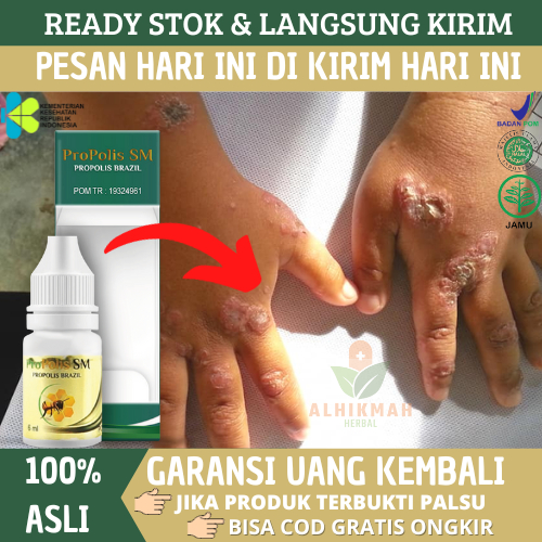 Obat Budug Di Kaki / Tangan, Obat Gatal Borok Budug Kudis Scabies Manusia, Obat Gatal Berair Bernana