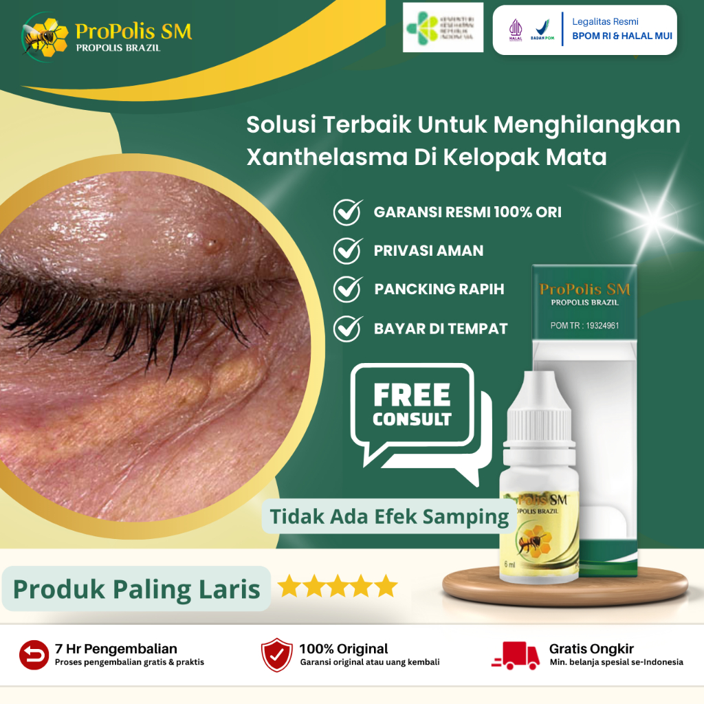 Obat Penghilang Xanthelasma Di Kelopak Mata Dengan Propolis SM