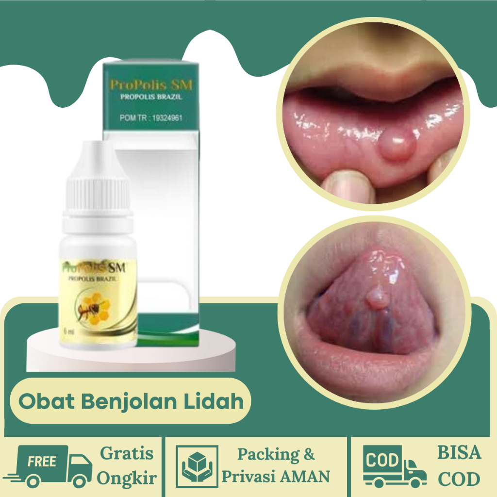 PROPOLIS SM Obat Benjolan Di Lidah,  Obat Herbal Pengempis Benjolan di Lidah, Obat Lidah Luka-Luka, 