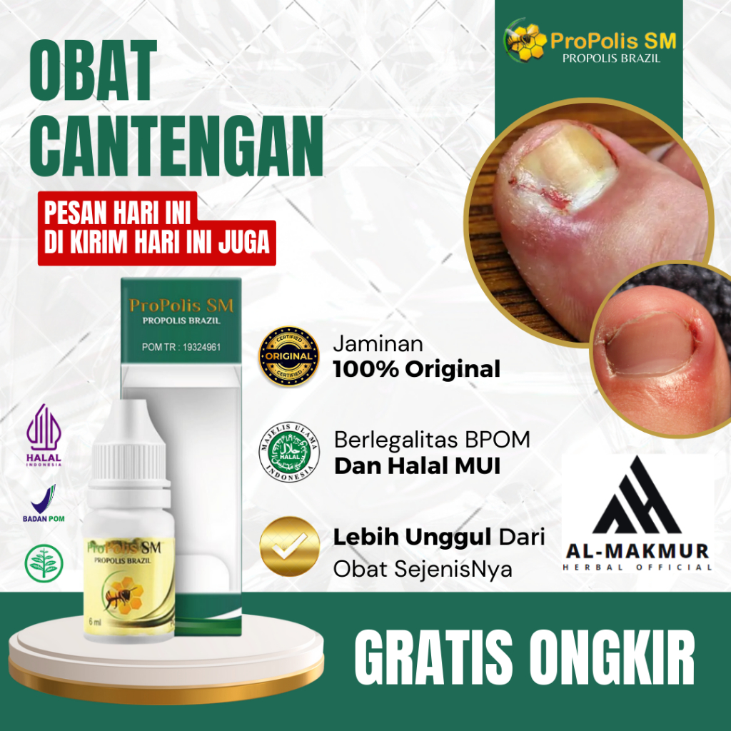 Obat Cantengan, Obat Cantengan Parah, Obat Kuku Rusak, Obat Kuku Bengkak Bernanah, Obat Cantengan Pa