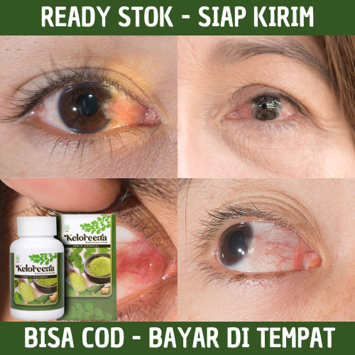 Obat Mata Berlemak, Obat Herbal Mata Berlemak, Obat Mata Pterygium, Obat Penghilang Lemak Di Mata, O