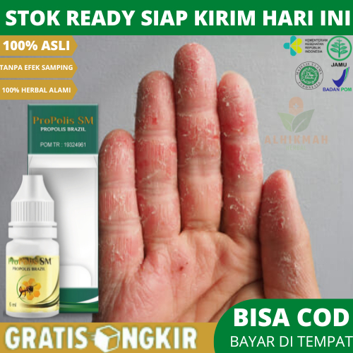 Obat Jari Tangan Kering Gatal Dan Pecah Pecah, Obat Kulit Jari Tangan Kering Mengelupas, Obat Telapa