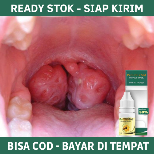 Obat Amandel Dewasa, Amandel Anak, Amandel dan Radang Tenggorokan, Amandel Tanpa Operasi, Radang Ama