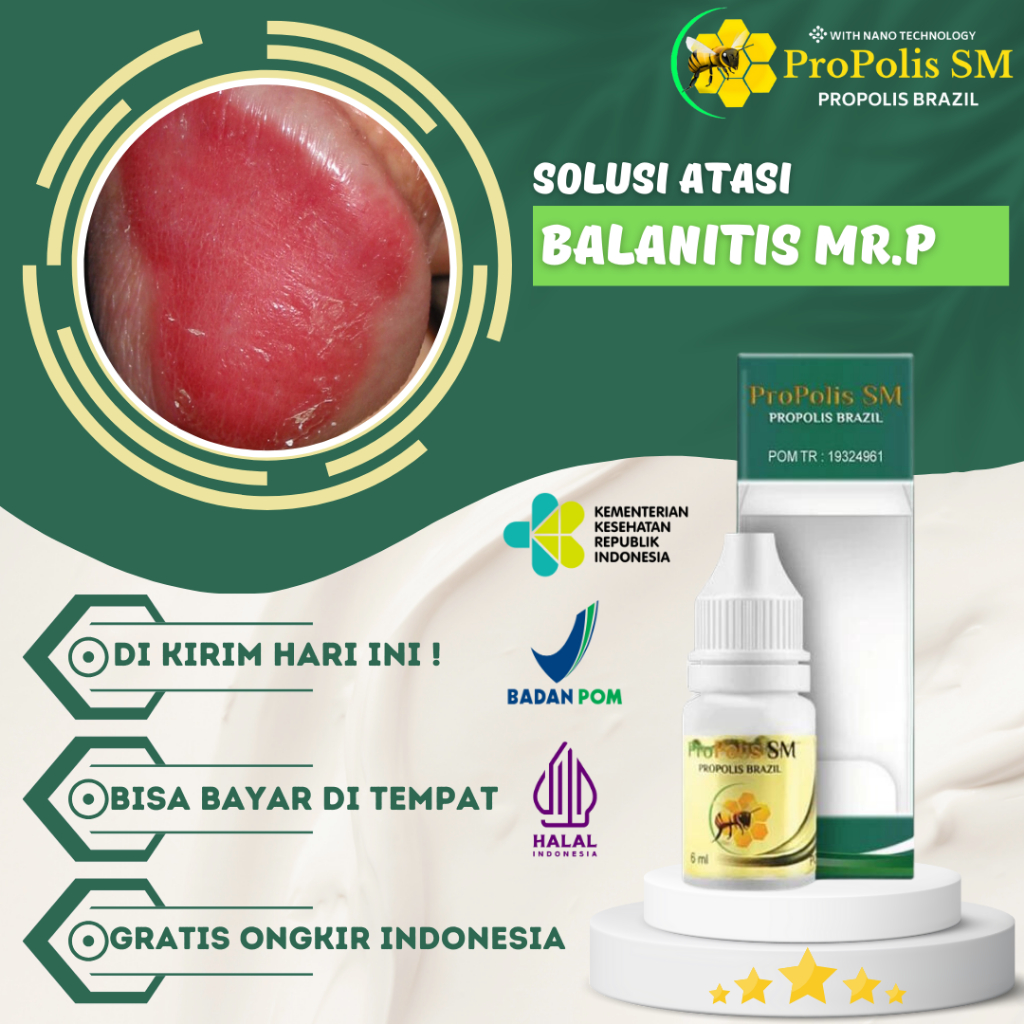 Obat Balanitis, Obat Lecet Mr.P di Bengkak, Obat Kutil Kelamin, Gatal Kemaluan Pria Batang Kelamin L
