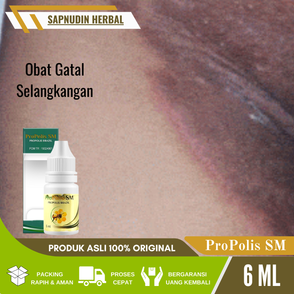 Obat Gatal Selangkangan, Obat Ruam Di Selangkangan, Obat Kesrek Di Selangkangan, Obat Kurap Selangka