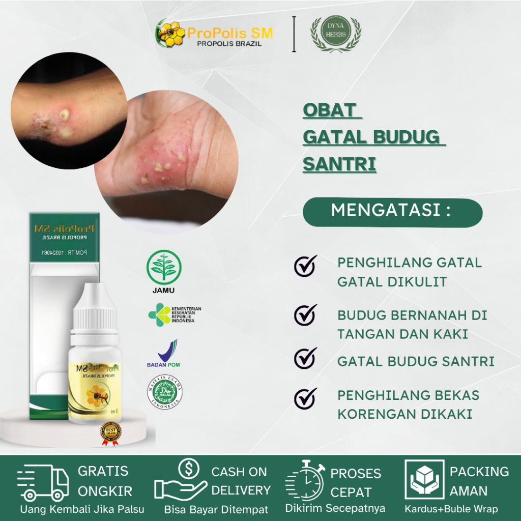 Obat Budug Kulit, Obat Gatal Budug Di Kaki, Obat Budug Santri, Obat Budug Bernanah, Obat Gudik Atau 