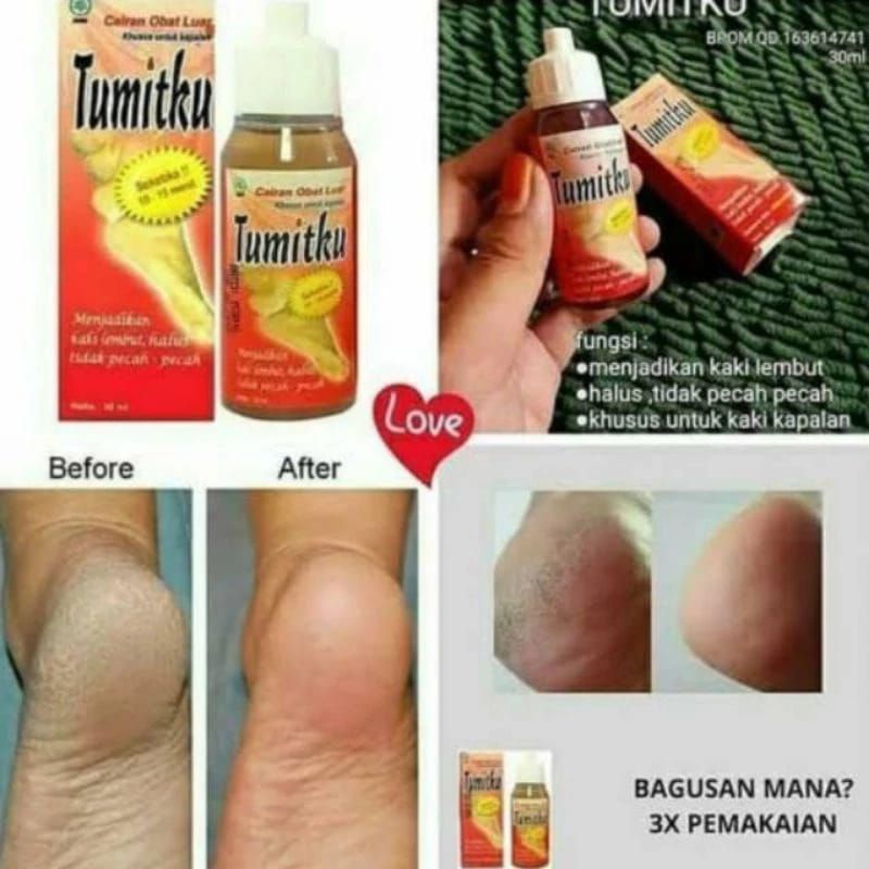 TUMITKU OBAT HERBAL KAKI PECAH
