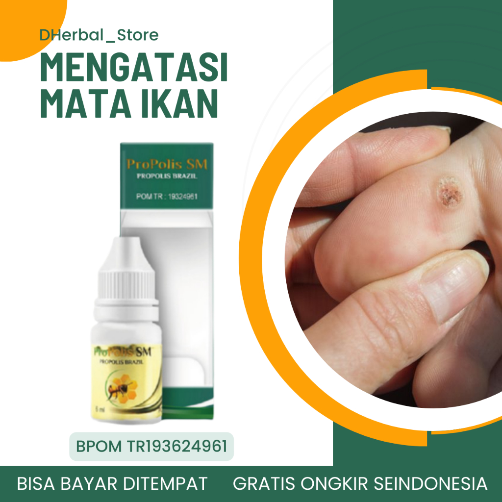 Obat Mata Ikan di Kaki, Obat Mata Ikan di Tangan Obat Clavus, Obat Kaki Kapalan, Obat Benjolan Keras