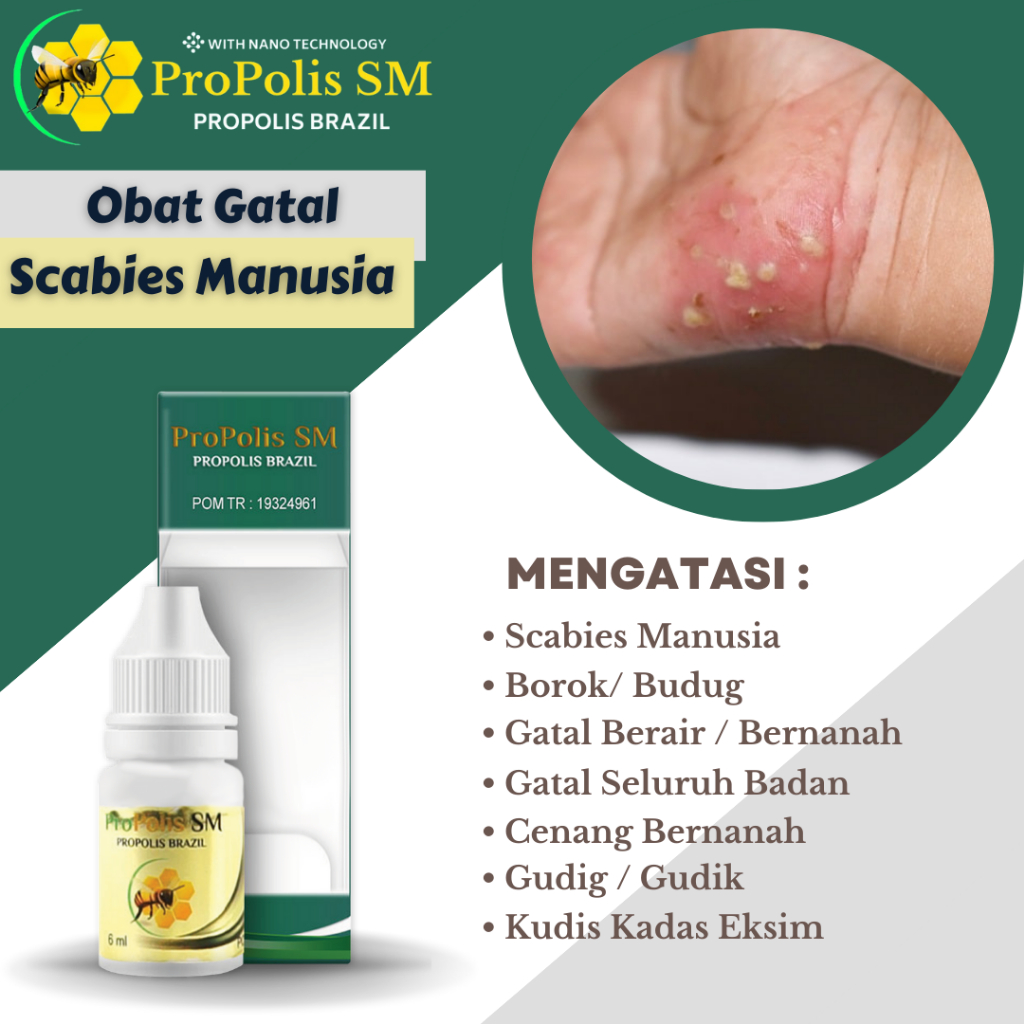 Obat Scabies Manusia, Obat Gatal Scabies, Gatal Kulit Seluruh Badan, Obat Budug, Obat Cenang Bernana