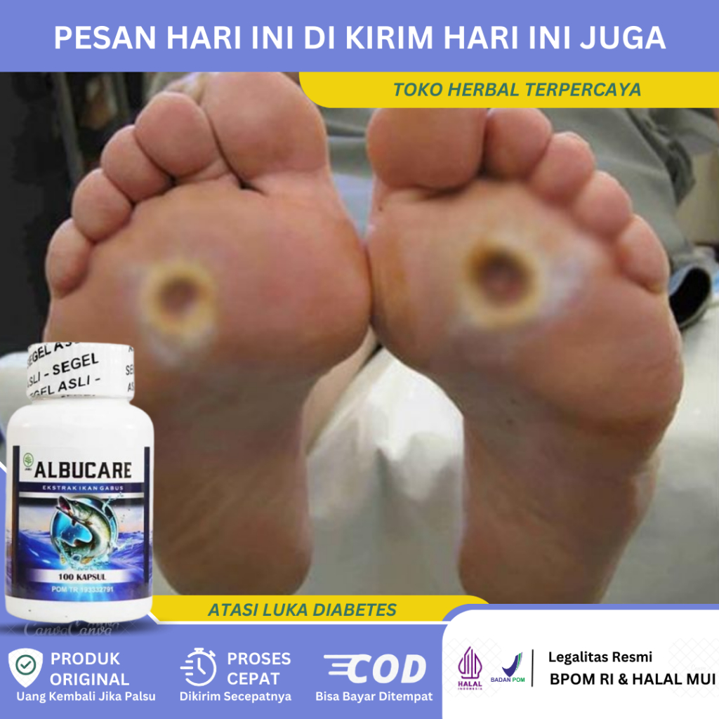 Obat Luka Diabetes, Obat Luka Diabetes Melitus, Obat Pengering Luka Diabetes, Obat Luka Diabetes Ker