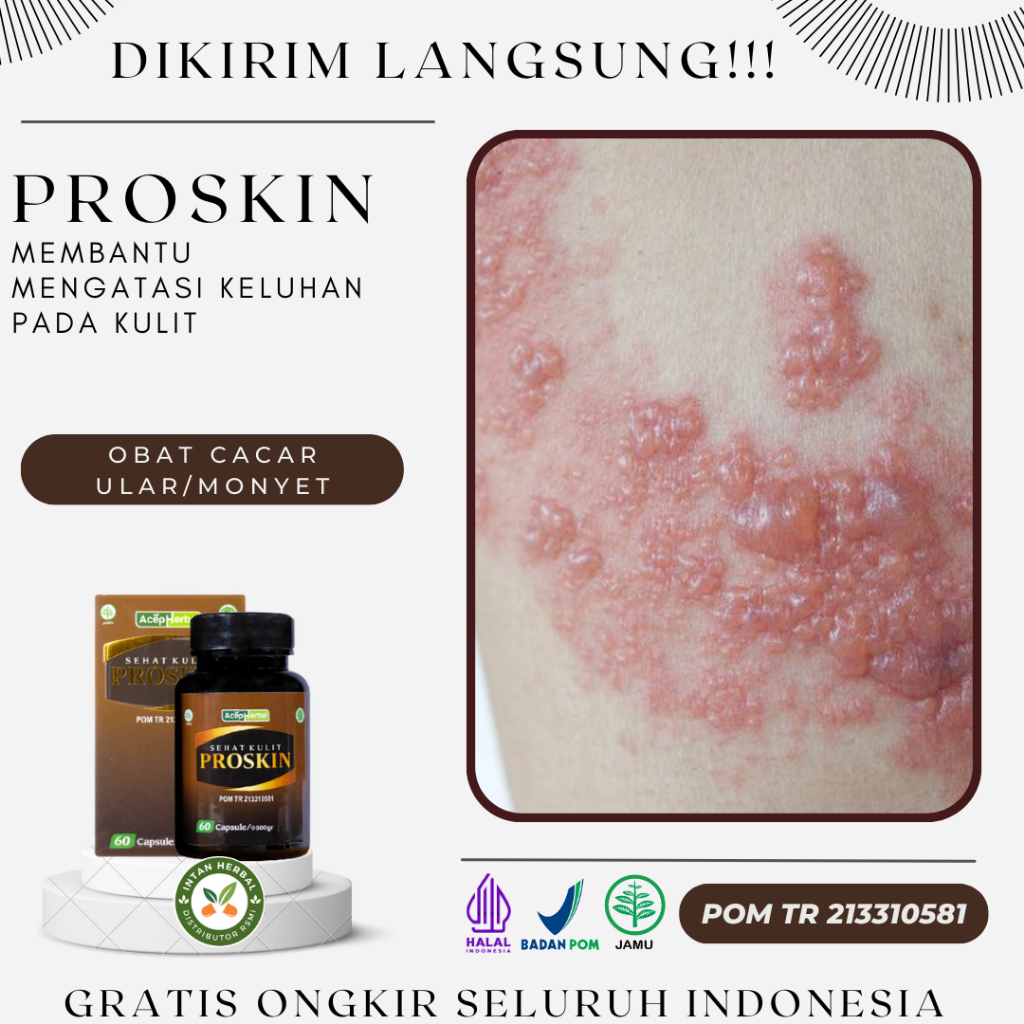 Proskin 100% Original - Obat Cacar Ular, Cacar Monyet, Penghilang Bekas Cacar Ular, Obat Cacar Air C