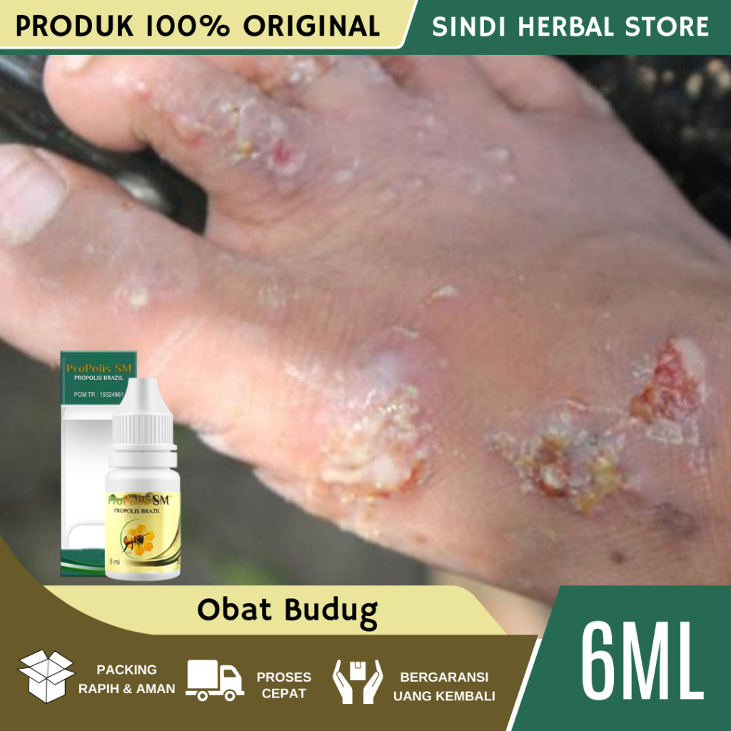 Obat Budug, Obat Budugan, Obat Budug Santri, Obat Budug Anak, Obat Budug Dewasa, Obat Budug Bernanah