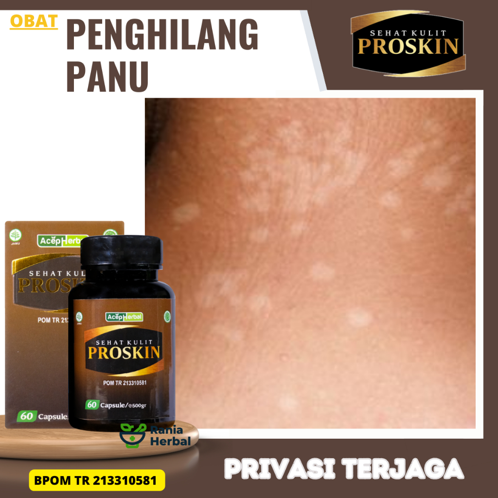 Obat Penghilangkan Panu, Obat Penghilangkan Bercak Putih, Obat Infeksi Jamur, Obat Kurap, Obat Hapur