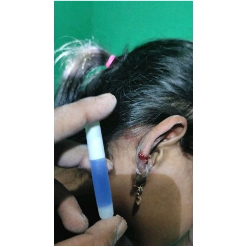 

lem sunat / lem khitan