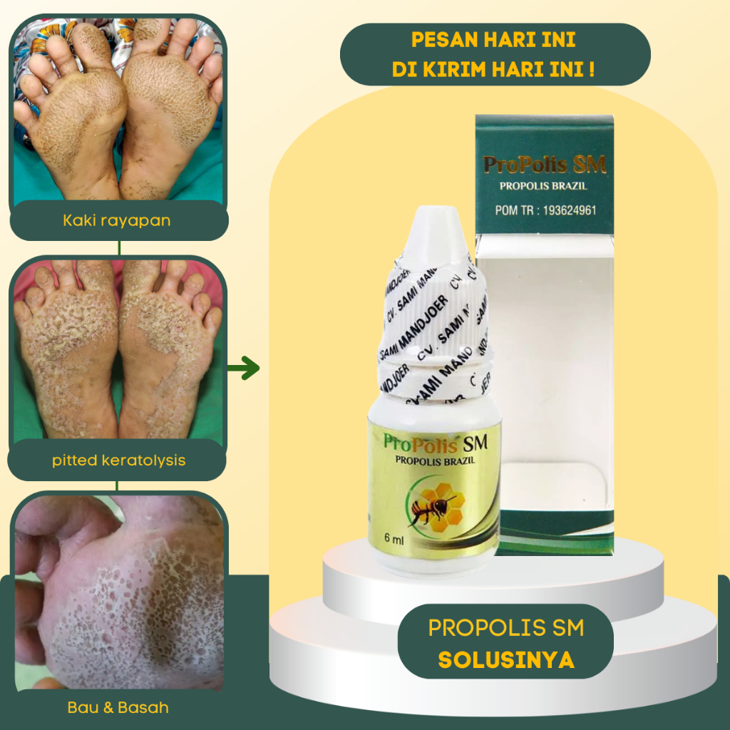 Obat Kaki Rayapan dan Bau - Obat Kaki Berlubang - Telapak Kaki Bolong Bolong - Salep Kaki Rayapan - 