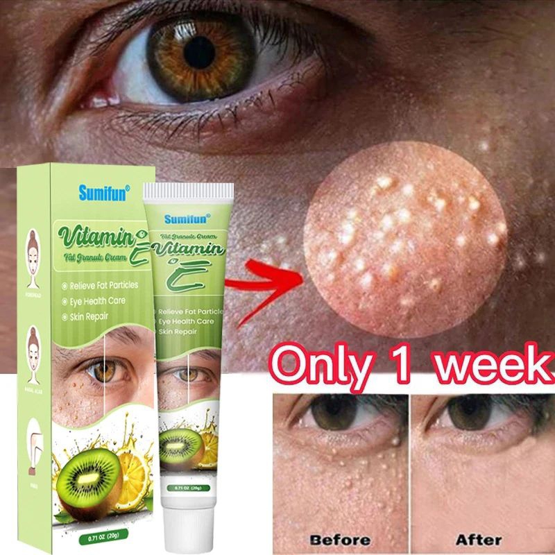 vitamin penghilang milia syringoma xanthelasma butiran lemak sekitar mata