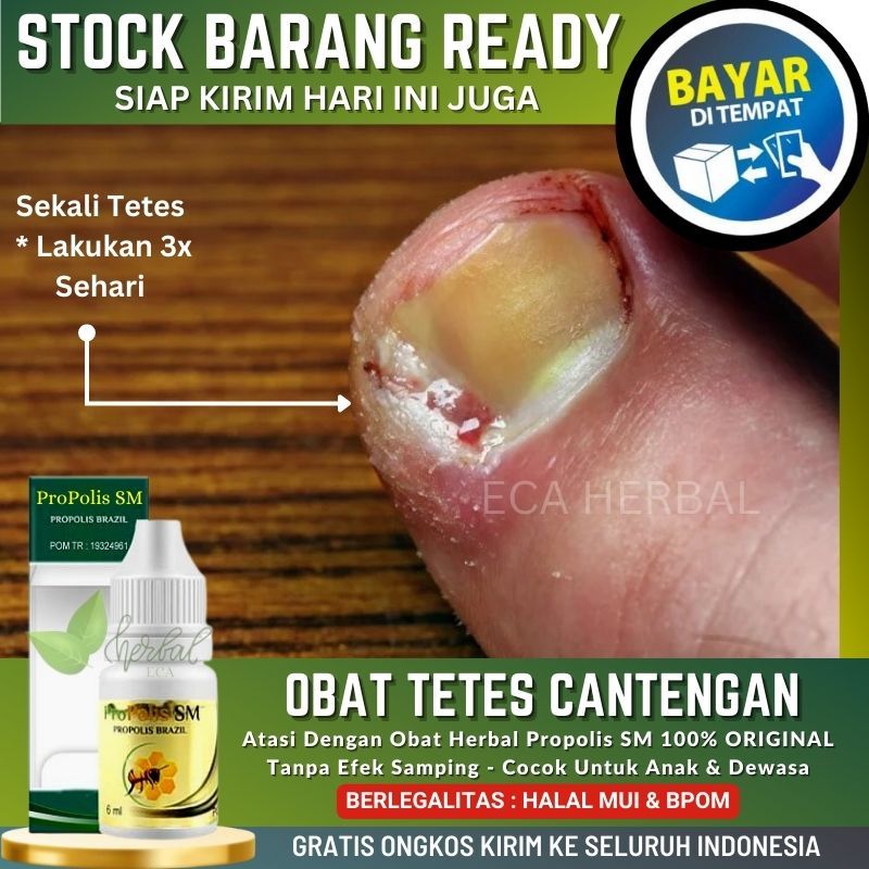 Obat Tetes Antibiotik Khusus Infeksi Cantengan Obat Menormalkan Kuku Cantengan Yang Bau Lembek Kunin