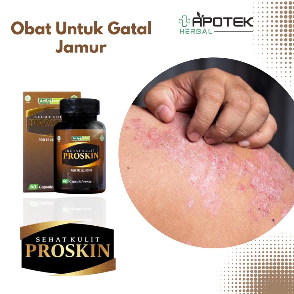 Obat Gatal Jamur Kulit Kurap Panu Eksim Psoriasis Kandidiasis Gatal Kulit Bersisik Seluruh Badan Gat