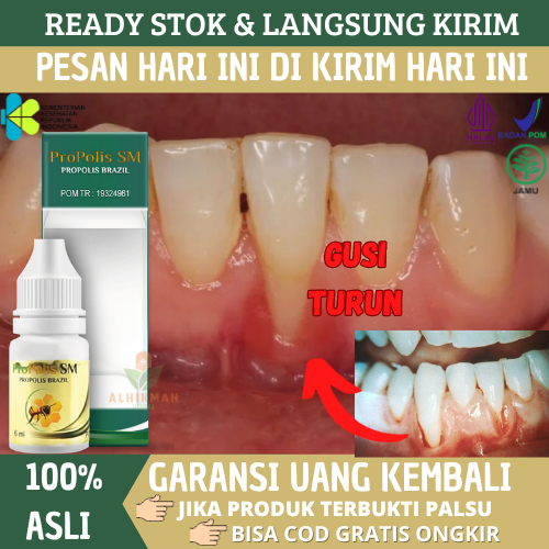 Obat Resesi Gingiva Periodontitis / Gusi Turun, Obat Gigi Turun, Obat Gusi Bengkak Dan Berdarah, Oba