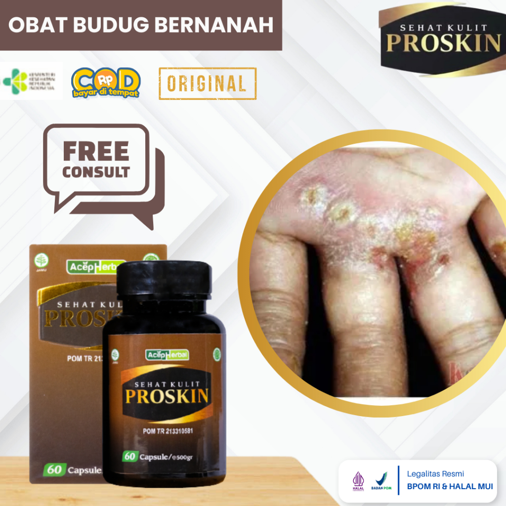 Obat Budug Bernanah, Obat Gatal Budug Bernanah, Obat Borok Bernanah, Obat Cenang Bernanah, Obat Budu