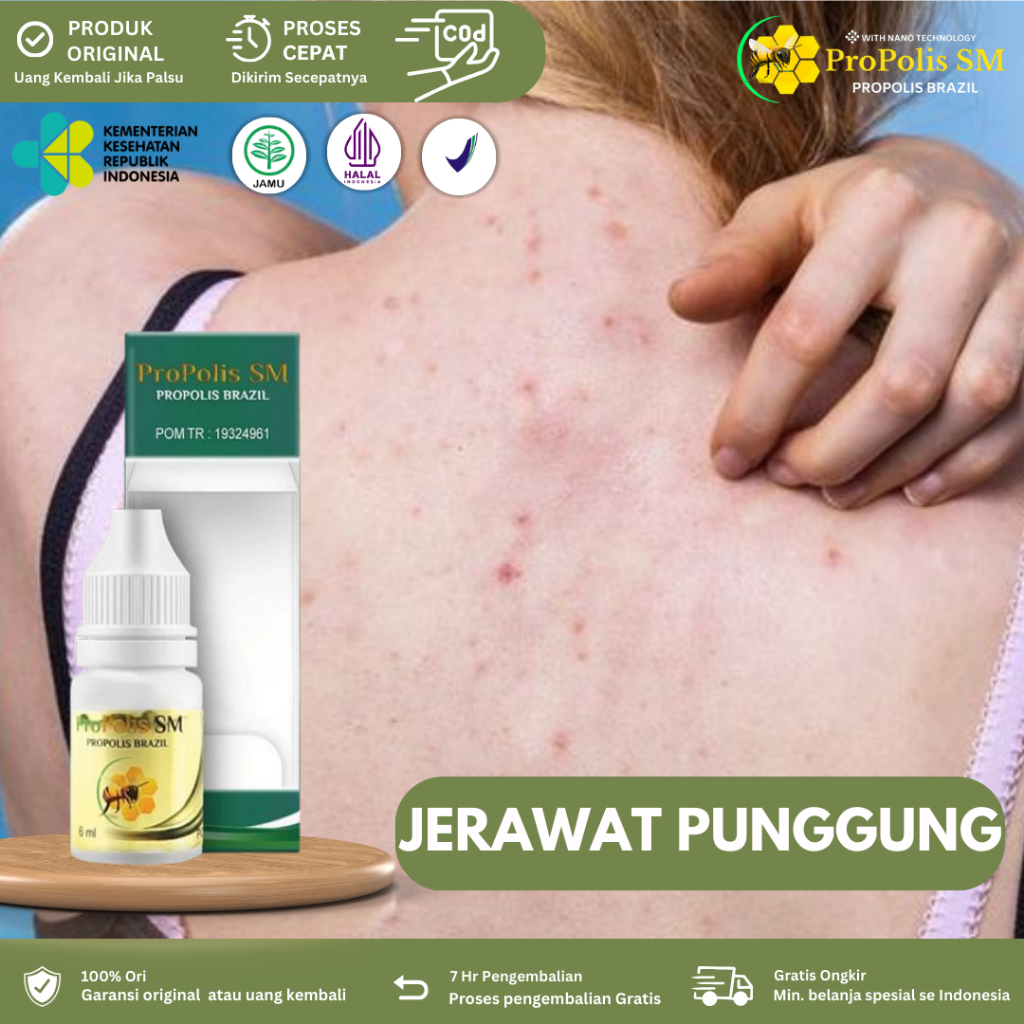 Obat Jerawat punggung, Penghilang Jerawat Punggung dan di Badan, Salep Jerawat punggung, Obat jerawa