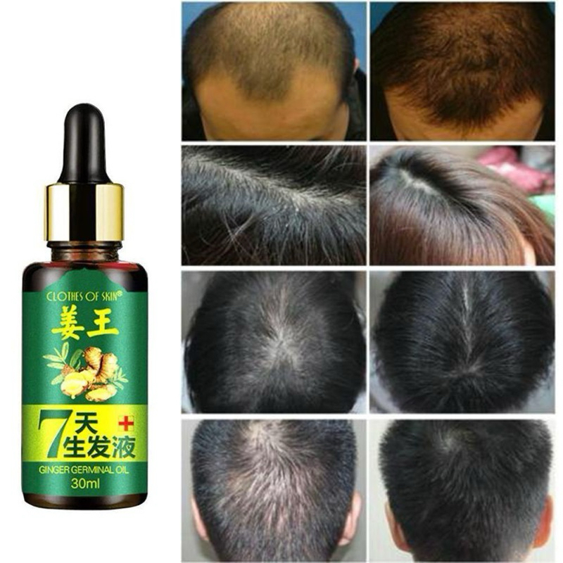 7 Days Ginger Germinal Oil Serum Penumbuh Rambut Rontok Botak