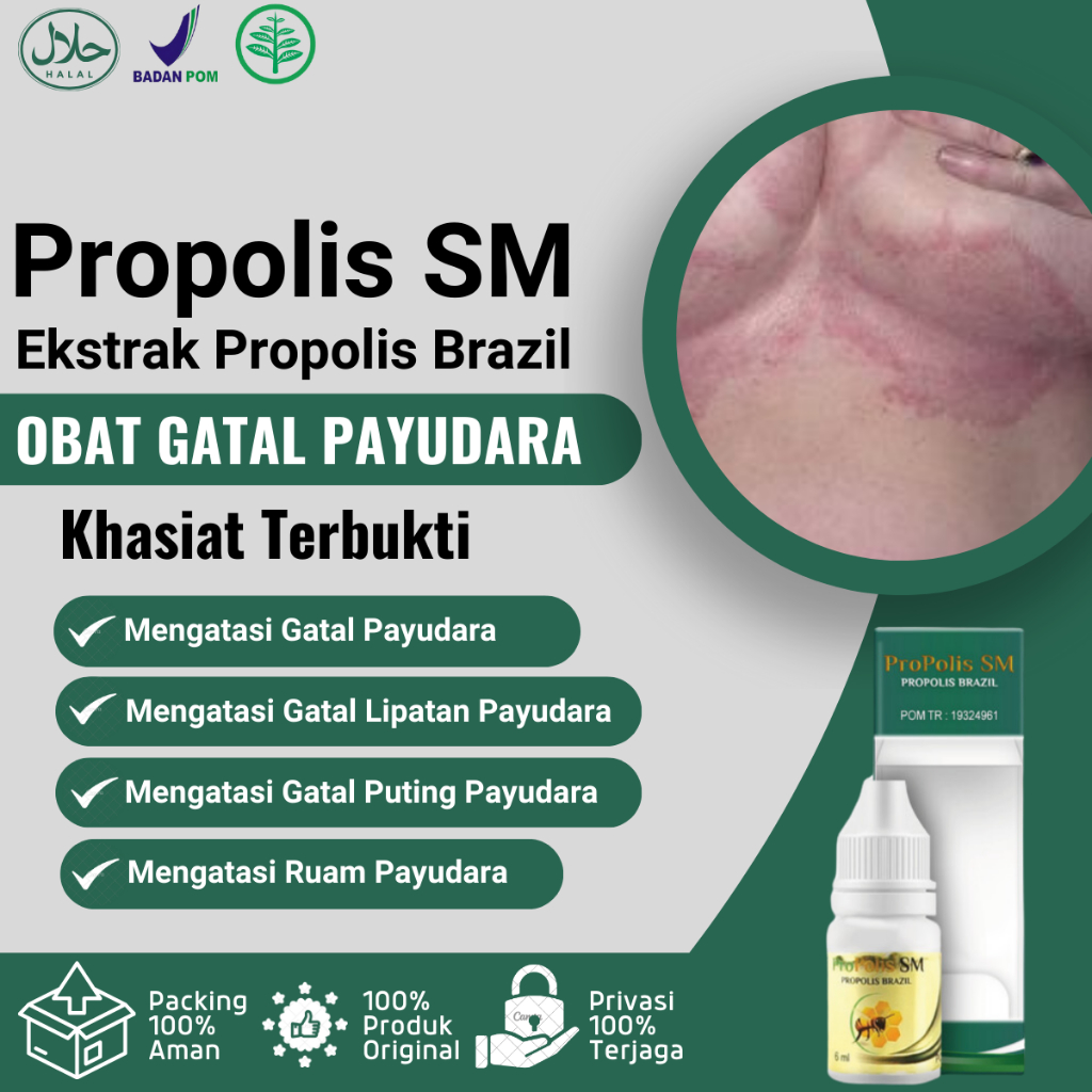 Obat Gatal Payudara, Obat Gatal Lipatan Payudara, Iritasi Payudara, Salep Gatal Payudara, Puting Gat