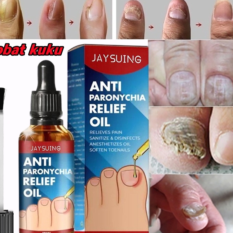 obat kuku jamur dan rusak vitamin kuku 1ml obat jamur kuku Perawatan Jamur Kuku Paronychia Perawatan