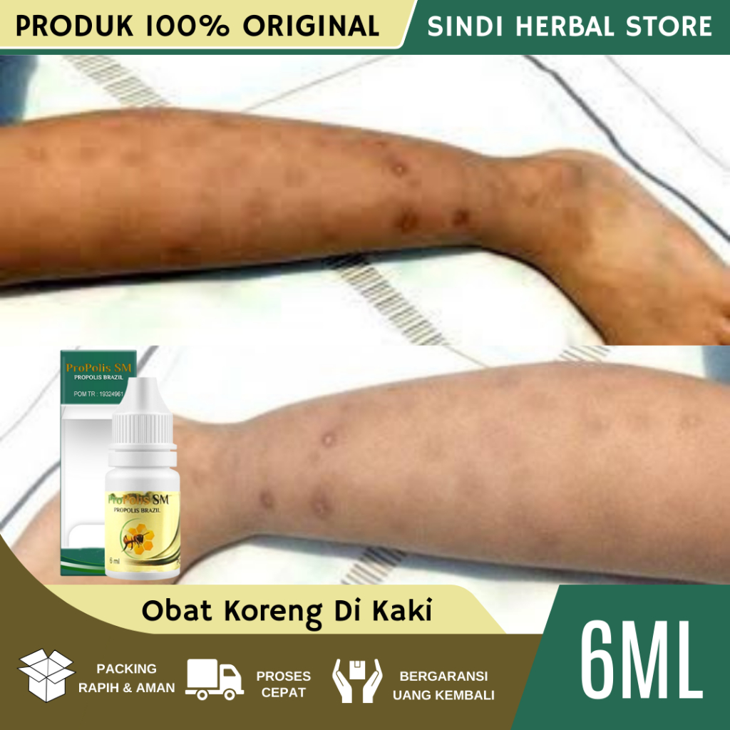 Obat Koreng Di kaki, Obat Penghilang Bekas Koreng, Luka Bernanah, Penghilang Bekas Luka, Menghilangk