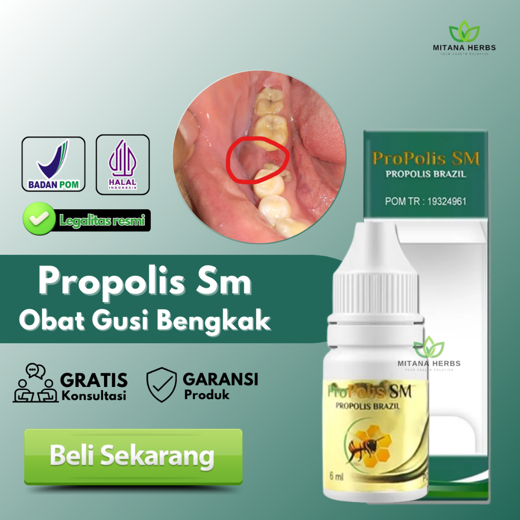 Obat Gusi Bengkak, Obat Radang Gusi Bengkak, Obat Gusi Bernanah, Obat Gusi Bengkak Karena Gigi Berlu