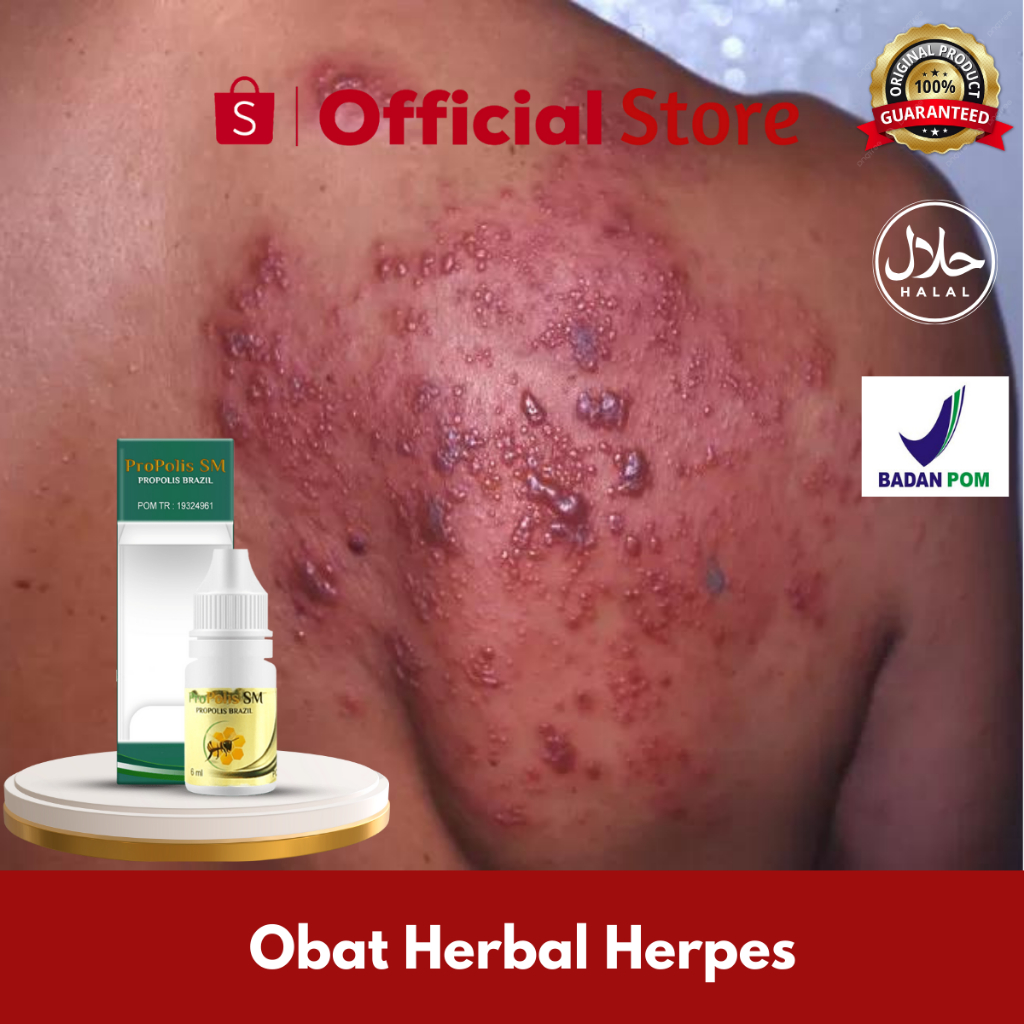 Obat Herpes, Obat Herpes Zoster, Simplex, Genital, Herpes Kelamin, Obat Herpes Kulit Pada Bayi, Anak
